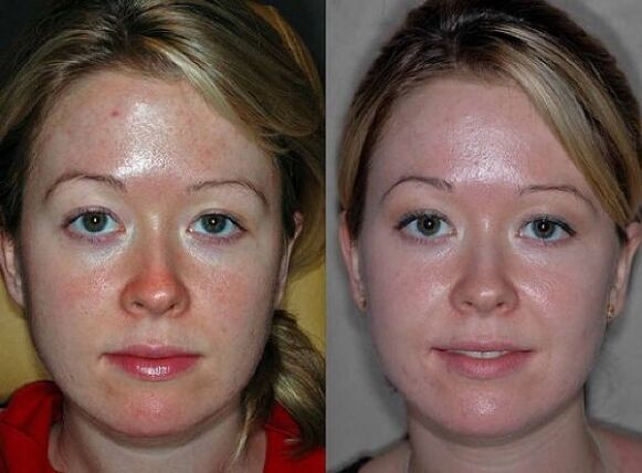 Photos before and after plasma rejuvenation surgery