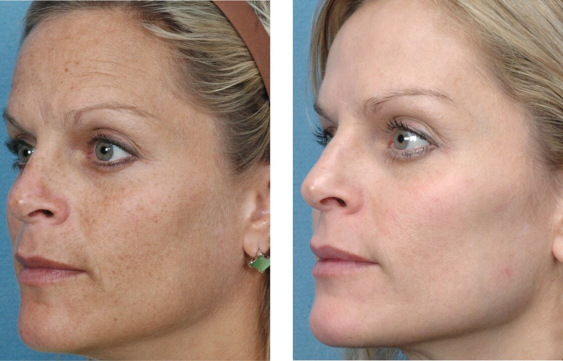 Before and after skin rejuvenation photos 1
