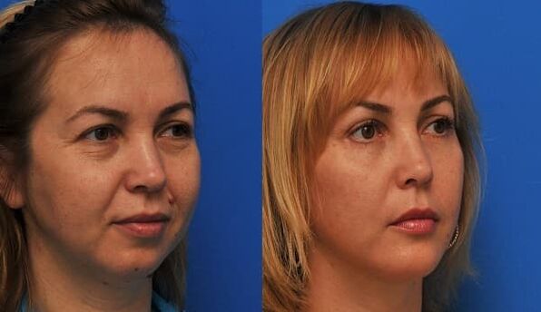 Before and after firming and rejuvenation photos 1
