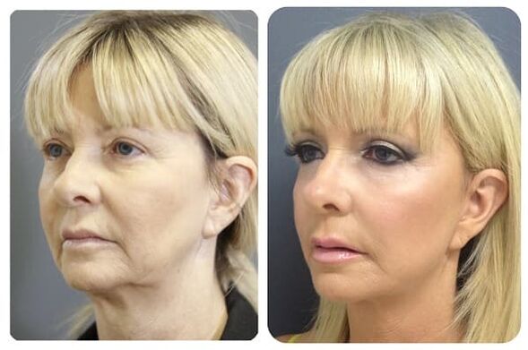 Before and after firming and rejuvenation photos 2