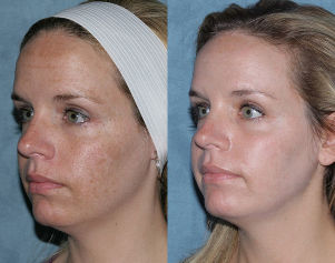 Photos before and after fractional rejuvenation of the face