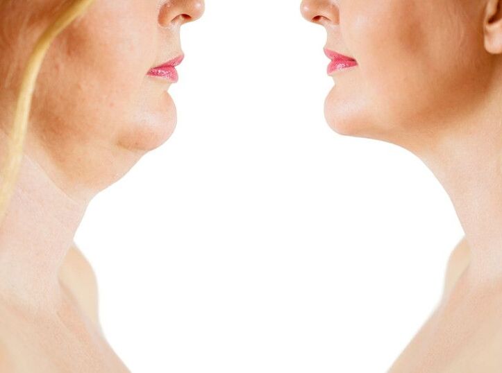 Causes of neck skin aging