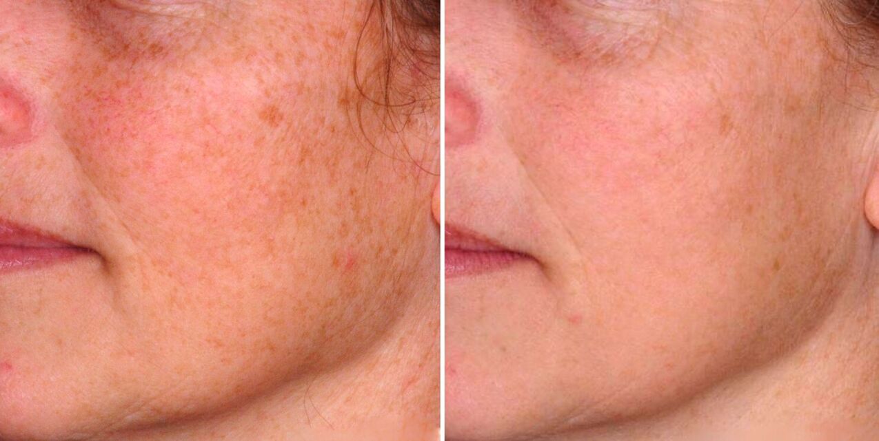 Part of the photothermal action results in the reduction of age spots on the facial skin. 