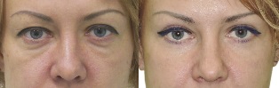 Before and after the eyelid contour