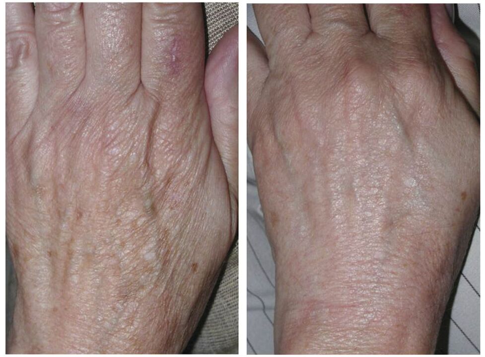 Before and after laser rejuvenation photos