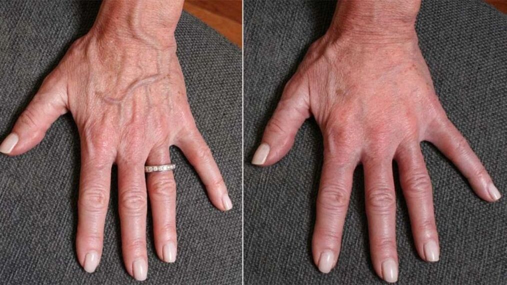 Contour shaping, hand rejuvenation photo 1 and before