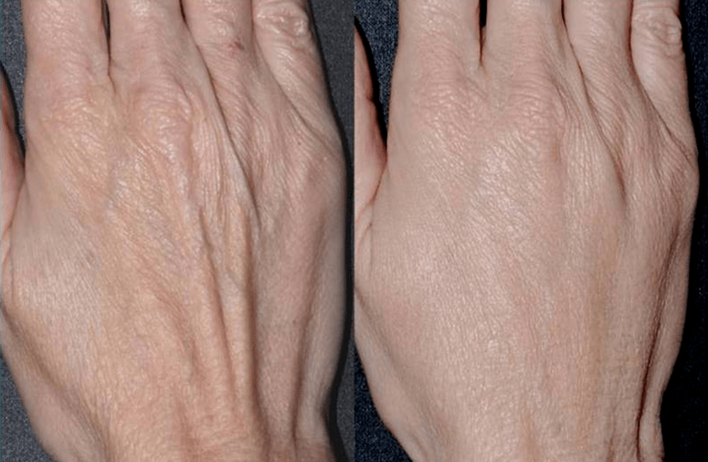 Contour shaping, hand rejuvenation photo 2 before and after