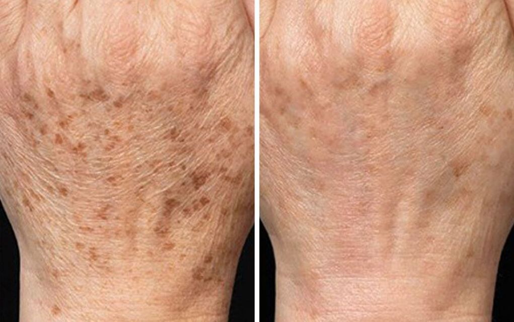 Hands peeling before and after photos